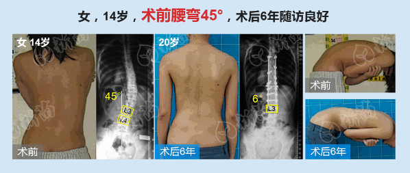 特发性脊柱侧弯手术 最大保留功能案例